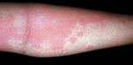 Urticaria