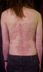 Psoriasis