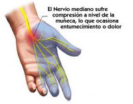 Dolor carpiano (paritarios.cl)