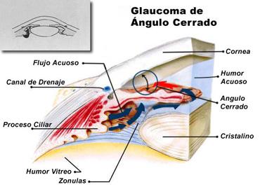 Glaucoma de angulo cerrado