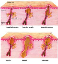 Formas típicas de acné (Imagen: zonamedica.com.ar)