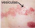 Ampollas de culebrilla (Herpes Zoster)