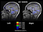 MRI funcional del cerebro de una persona que sufre dolor (Foto: rsd-crps.co.uk)