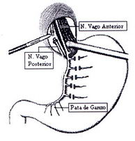 Vagotomía gástirca