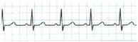 Paciente con electrocardiograma normal