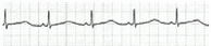 Electrocardiograma de un paciente con síndrome de QT largo