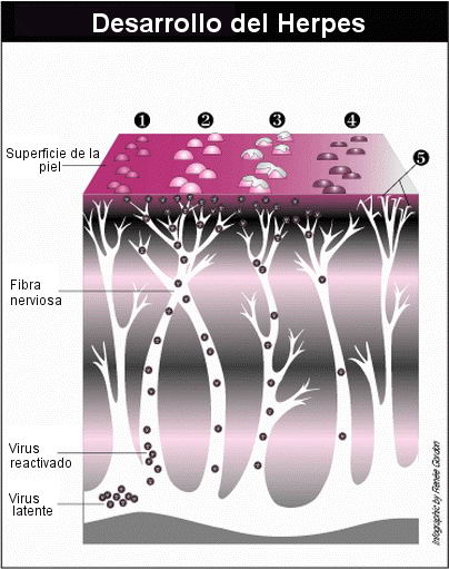 Desarrollo del herpes zóster