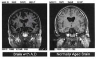 Cerebro con enfermedad de Alzheimer comparado con uno normal en imágenes capturadas por RMN (Imagen: wikipedia.org)