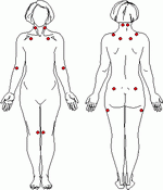 Puntos marcadores de la fibromialgia