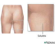 Celulitis (imagen: nlm.nih.gov)
