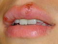 Herpes simple en el labio