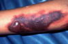 Síntoma externo del dengue hemorrágico (easia2u.com)